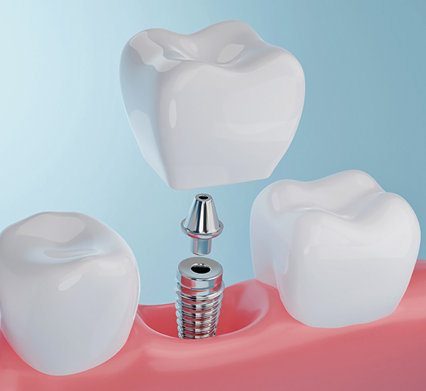 Dental Implants | Birmingham, AL | WISE Oral - Dental-Implants-2(1)