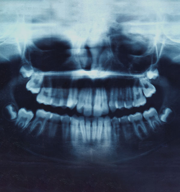 Painless Wisdom Teeth Removal | Birmingham, AL | WISE Oral - wisdomteethrev4